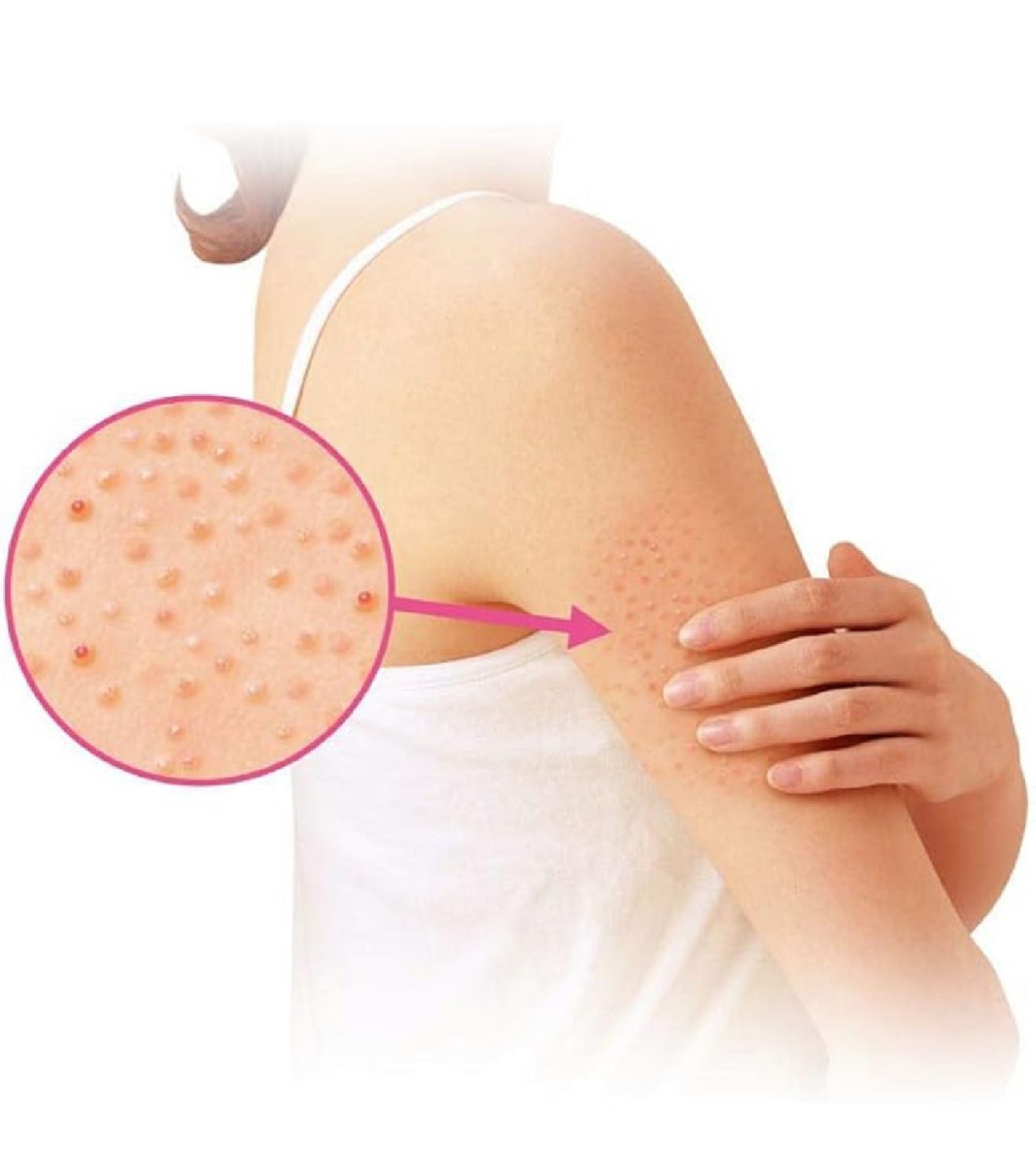 KOBAYASHI - Nino Cure Cream for Keratosis Pilaris 30g