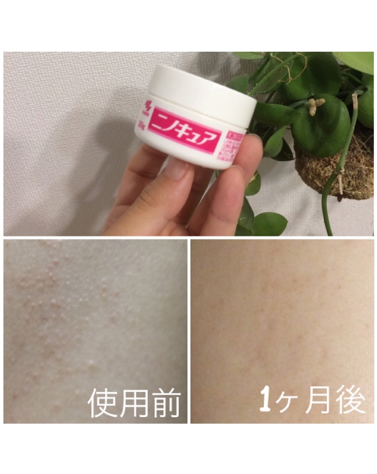 KOBAYASHI - Nino Cure Cream for Keratosis Pilaris 30g